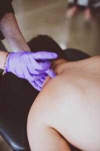 Dry Needling at Motion Physical Therapy